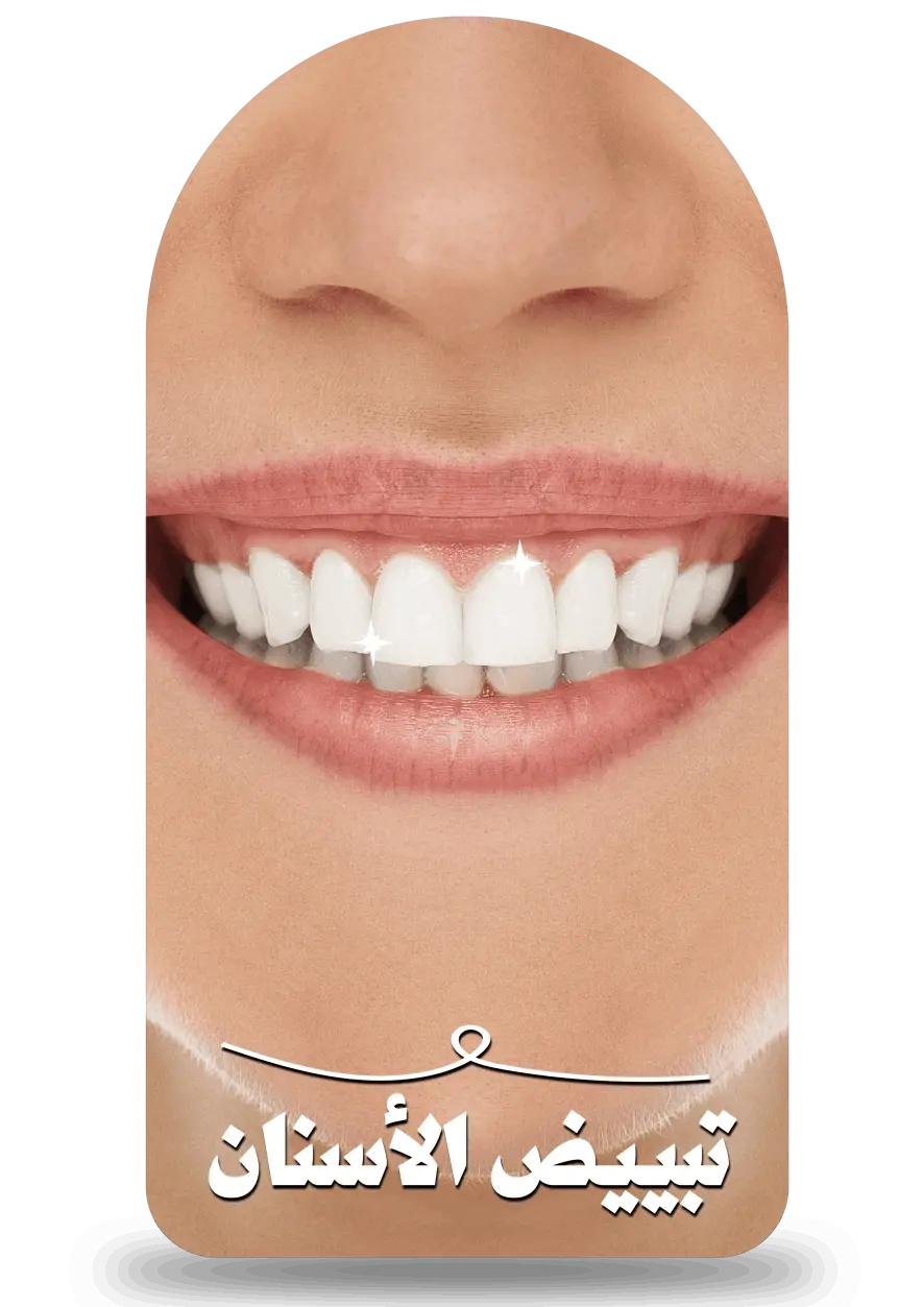 تبييض الأسنان